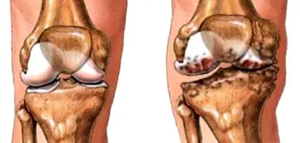 osteoarthritisének