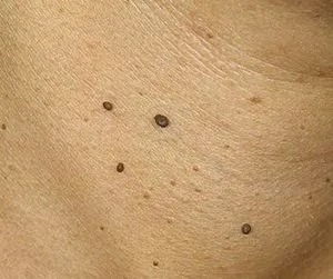Tűnő papilloma nyakán