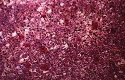 Mi perifocal ödéma
