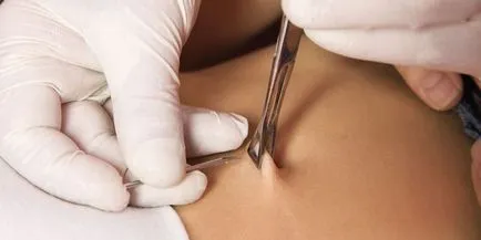 Hogyan lehet gyógyítani a köldök piercing