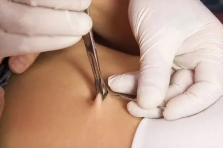 Hogyan lehet gyógyítani a köldök piercing