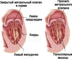 Prolapsus a szív, hogy ez Prolapsus a szív, hogy ez