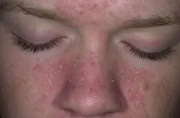 Mi seborrheás dermatitis