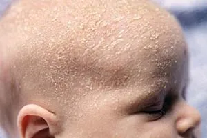 Mi seborrheás dermatitis Mi seborrheás dermatitis