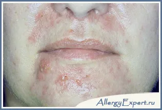 Mi seborrheás dermatitis