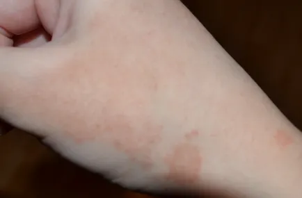 Kis test kiütés valamiből