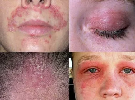Mi seborrheás dermatitis Mi seborrheás dermatitis