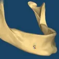 set implantátumok