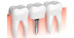 set implantátumok