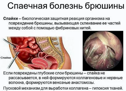 Összenövések hogyan kell kezelni