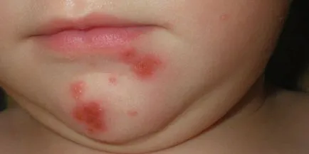 Hogyan kezeli streptoderma