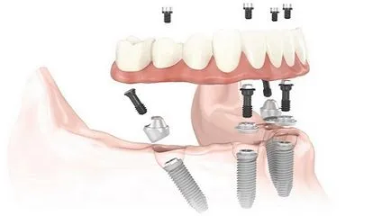 set implantátumok