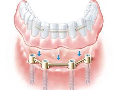 set implantátumok