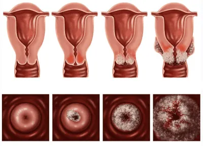 Hogyan juthat HPV Hogyan juthat HPV