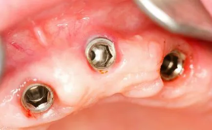 set implantátumok