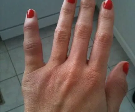 Mi a teendő, ha a kificamodott ujját Mi a teendő, ha a kificamodott ujját