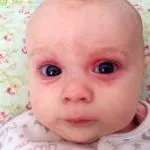 Chalazion kezelése a gyermek