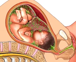 Hogyan lehet gyógyítani chlamydia
