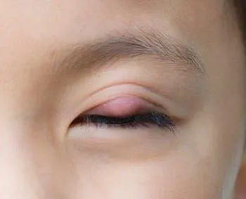 Chalazion kezelése a gyermek