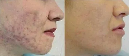 Hámló bőr vélemények