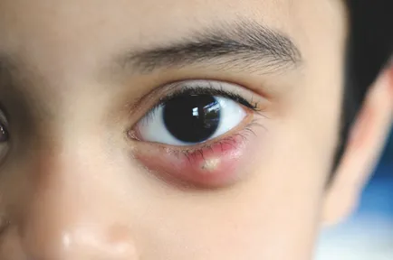 Chalazion kezelése a gyermek