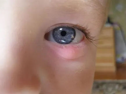 Chalazion kezelése a gyermek Chalazion kezelése a gyermek
