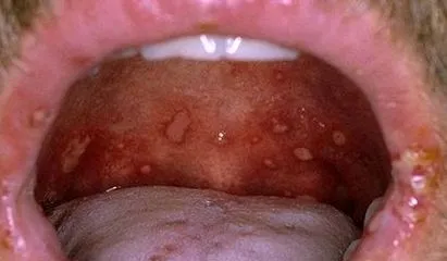 pemphigus felnőtteknél
