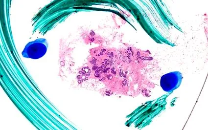 intraductalis papilloma