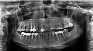 set implantátumok