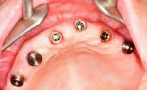 set implantátumok
