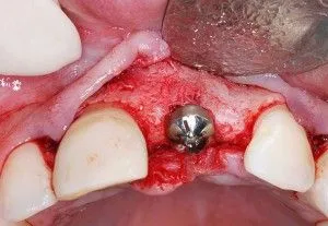 set implantátumok