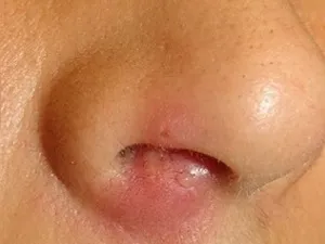 A kezelés a Staphylococcus aureus az orrban