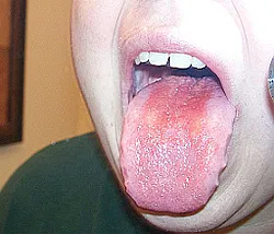 Aphthous stomatitis - okai, tünetei, diagnózis és kezelés (stomatitis) Aphthous stomatitis - okai, tünetei, diagnózisa és kezelése