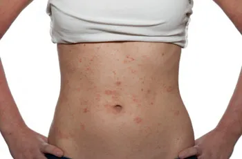 Allergiás a bőrre, okok, tünetek, kezelés, típusú allergének betegség (duzzanat) Allergiás a bőrt, okoz, a tünetek, a kezelés, típusú allergének betegség