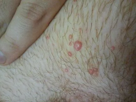 Allergia zsír (kenőanyagok) nőknél - a tünetek (allergiás) Allergia zsír (kenőanyagok) a nők - Tünetek