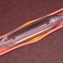 vascularis restenosis és az artériás ballon, lézer és koszorúér