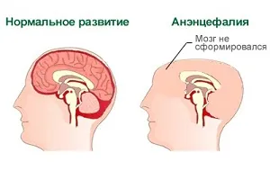 Anencephalia magzat okoz, diagnózis, a beteg fotók
