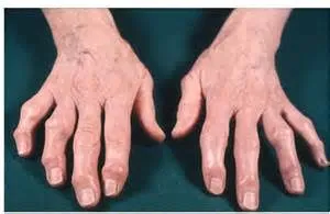 Osteoarthritis a kis ízületek a kéz ujj tünetek, hogyan kell kezelni az emberek segítségével, torna, edzés