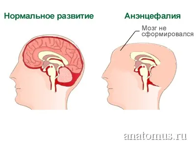 Anencephalia emberben