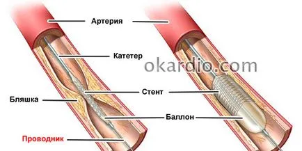 Angioplastica indikációk, előkészítése, hogy az eljárás, a kockázatok (átmegy) Angioplastica jelzések, előkészítése, hogy az eljárás, a kockázatok