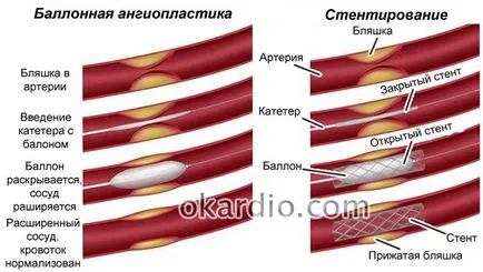 Angioplastica indikációk, előkészítése, hogy az eljárás, a kockázatok (angioplasztika) Angioplastica jelzések, előkészítése, hogy az eljárás, a kockázatok