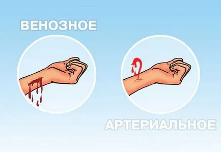 Az artériás vérzés tünetei és az elsősegély, hogyan kell megállítani a vérzést