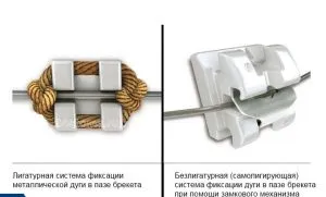 Nadrágtartók ligatúra és bezligaturnye (ligatúra) Nadrágtartók ligatúra és bezligaturnye