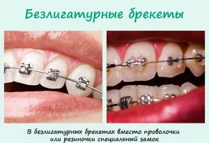Merevítő ligatúra és bezligaturnye (zárójelek) Nadrágtartók ligatúra és bezligaturnye