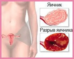 Fájó bal petefészke nők, miért húz, fáj, vagy colitis petefészek balra és mit kell csinálni