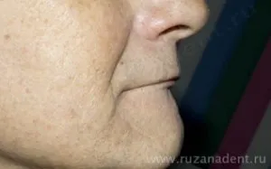 részleges fogsor
