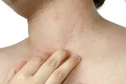 Hogyan kell kezelni allergiás a nap megelőzésére és kezelésére nap allergia (videó) (kezelt) Hogyan kell kezelni allergiás a nap megelőzésére és kezelésére nap allergia (videók)