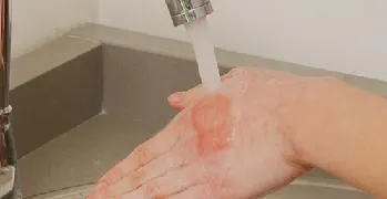 Mi van, ha égek forró vízzel elsősegély otthon