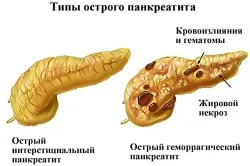 Mit tudok enni, ha a gyomorfájás (enterology otthon) Mit tudok enni, ha a gyomra fáj