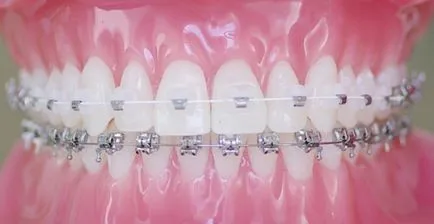 Melyek a önligírozó (bezligaturnye) Braces